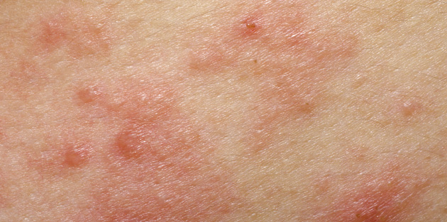 eczema