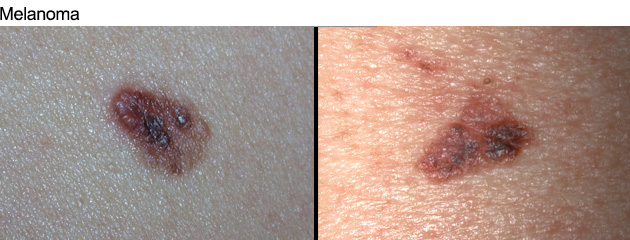 melanoma