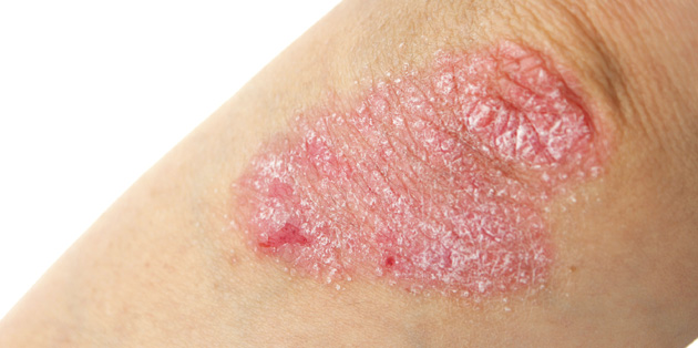 psoriasis