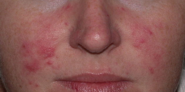 rosacea