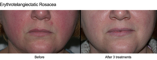 vbeam-rosacea