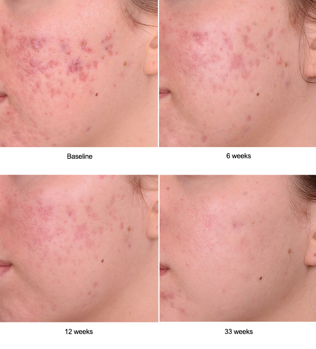 mild acne vulgaris