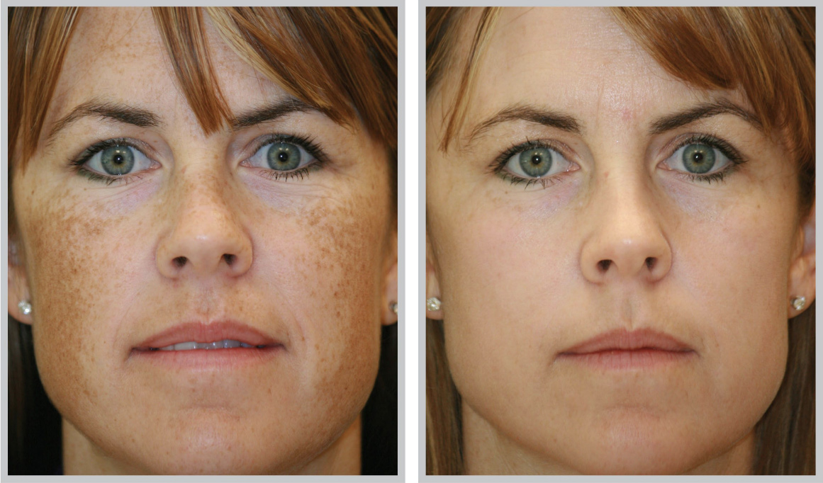 Laser Skin Tightening, Sydney Cosmetic Laser